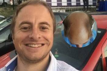 “Remontada épica”: El irreconocible antes y después de Coke Hevia tras implante capilar