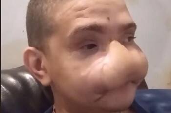 El drama del joven que vio su rostro destruido por un fuego artificial y que hoy es una celebridad en Tik Tok