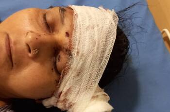 Mujer sobrevive luego de que asaltantes le enterraran un hacha en la cabeza