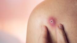 Forúnculos: tratamiento y prevención recomendados por la Clínica Alemana