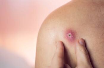 Forúnculos: tratamiento y prevención recomendados por la Clínica Alemana