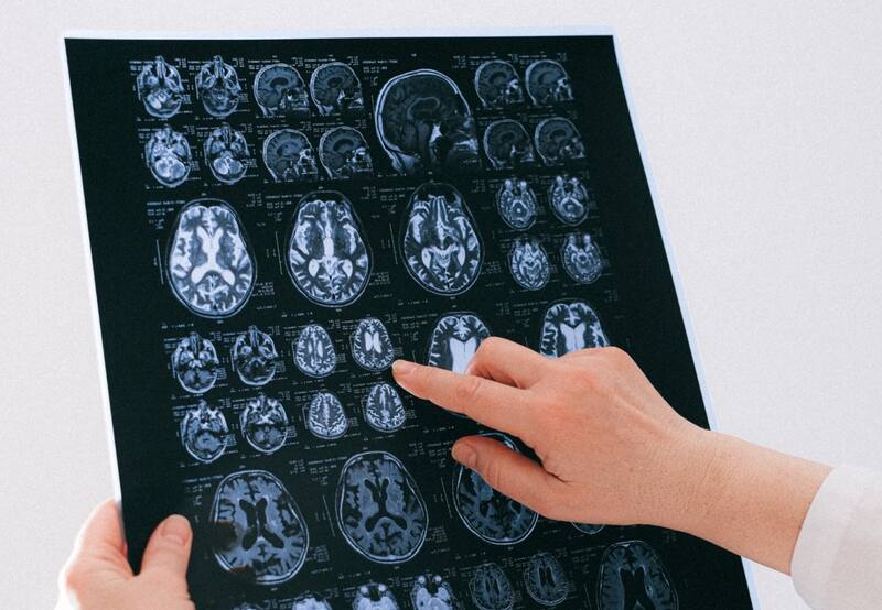 La pandemia del Covid-19 tuvo una repercusión dramática en el aumento de casos de Alzheimer | Foto: Befunky