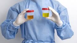 Orina con espuma: ¿Cuáles son las probables causas de este síntoma y cómo afecta a la salud?