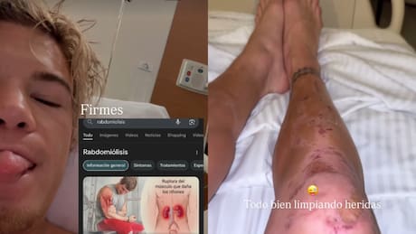 Rabdomiólisis: ¿En qué consiste la condición por la que fue hospitalizado Raimundo Cerda?