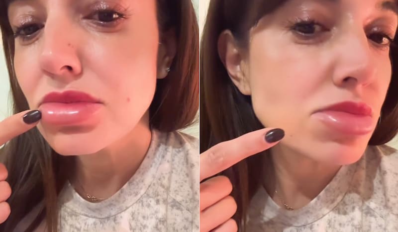 Yamila Reyna sufrió una terrible reacción alérgica.