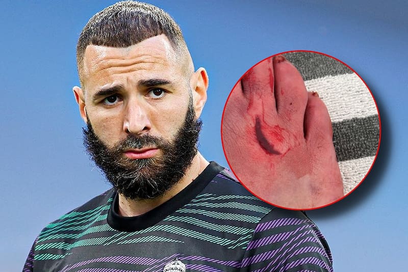 El delantero de Real Madrid Karim Benzemá jugó casi todo un partido con un corte en el pie derecho