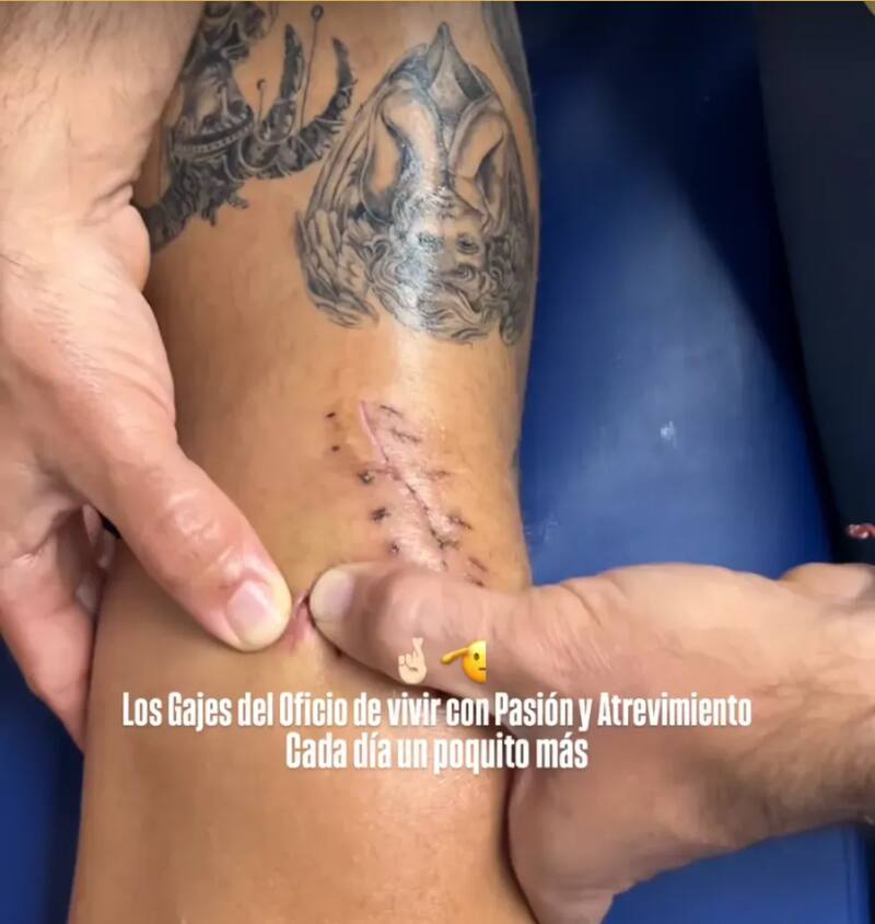 La cicatriz que le quedó a Igor Lichnovsky en su pierna derecha tras la operación.