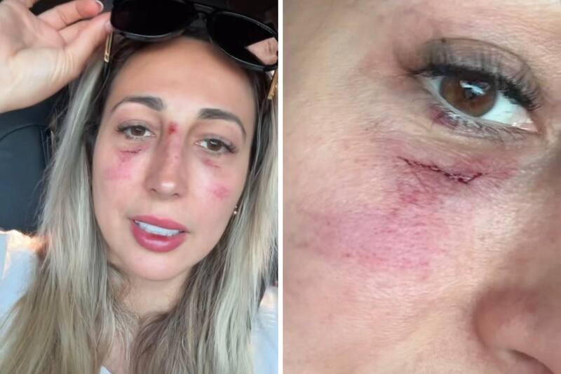 La influencer mostró cómo quedó su rostro tras grave accidente en moto.