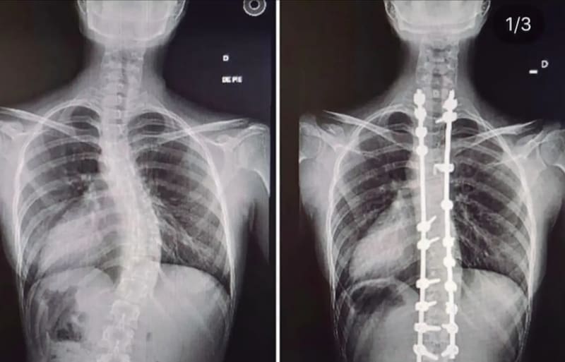 En sus redes sociales, la cientista política mostró cómo cambió su cuerpo tras someterse a una operación.