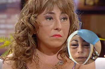 “El doctor me sacó toda la cara”: El impactante antes y después de Helhue Sukni tras peligrosa operación de rostro