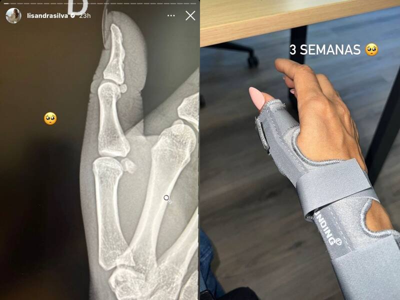 Historias de Lisandra Silva donde muestra su accidente