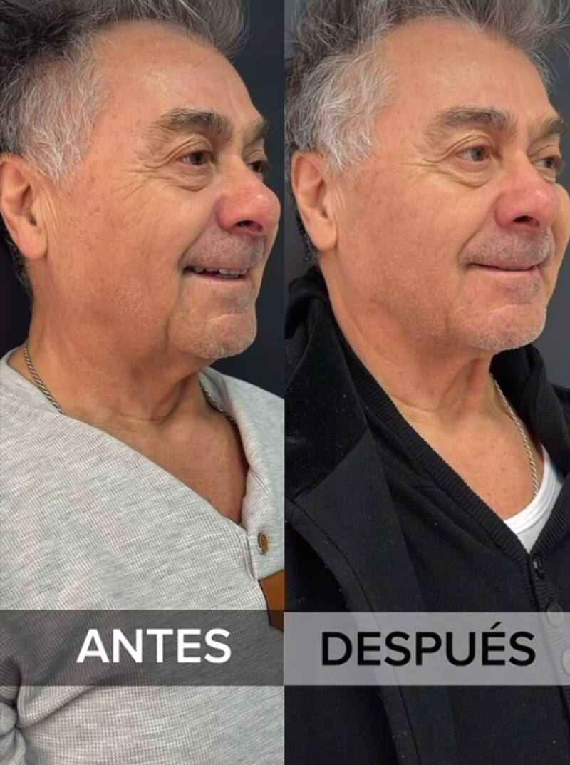 Pato Torres tras su intervención con hilos tensores. Créditos: Instagram