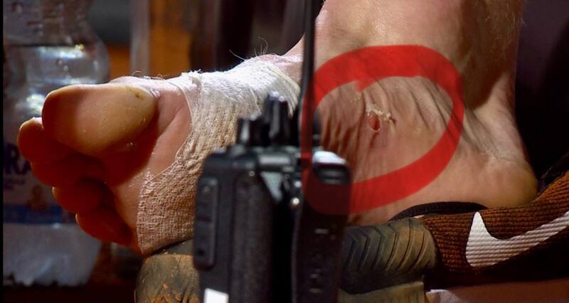 La ampolla que se le abrió al italiano en el partido contra Cerúndolo.