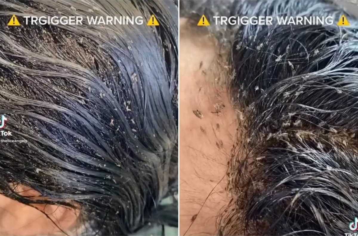 VIDEO I Terrible: niña llegó de urgencia al hospital con más de 15 mil piojos en su cabeza