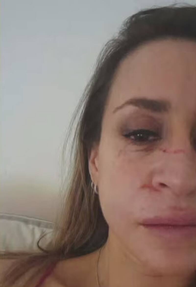Paola mostró la lesiones que supuestamente dejó Pedro Bastidas en su rostro.