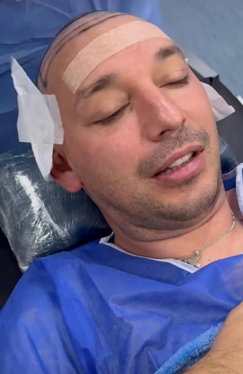Rodrigo Gallina se sometió a cirugía de injerto capilar.