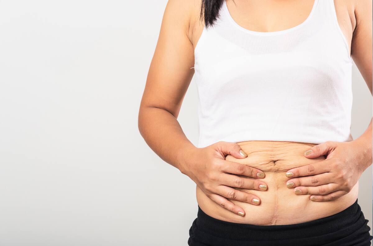 Abdominoplastia con bono PAD. ¿Cómo acceder y en qué casos es necesario realizarla?