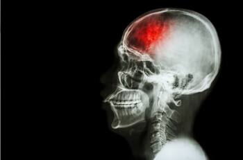 Harvard recomienda reemplazar este producto por un sustituto para reducir el riesgo de sufrir un accidente cerebrovascular