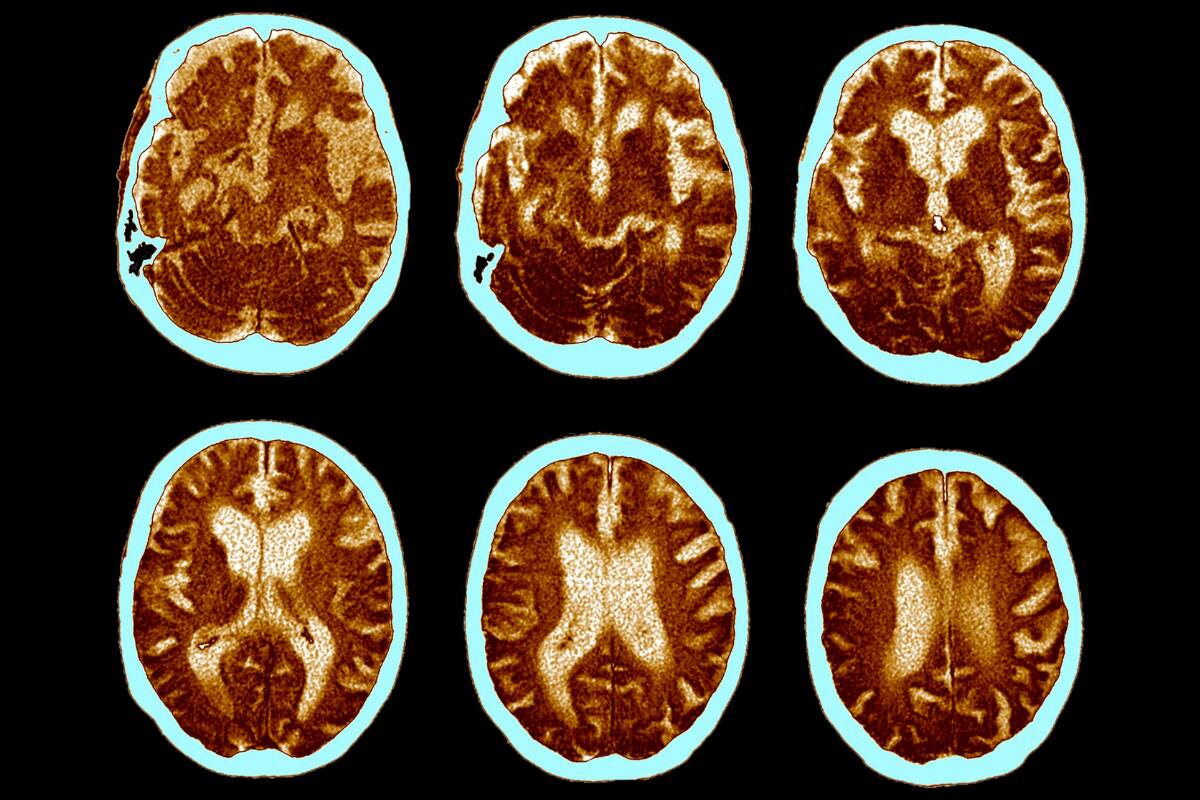 Este es un registro del avance de la enfermedad en el cerebro de una persona con Alzheimer