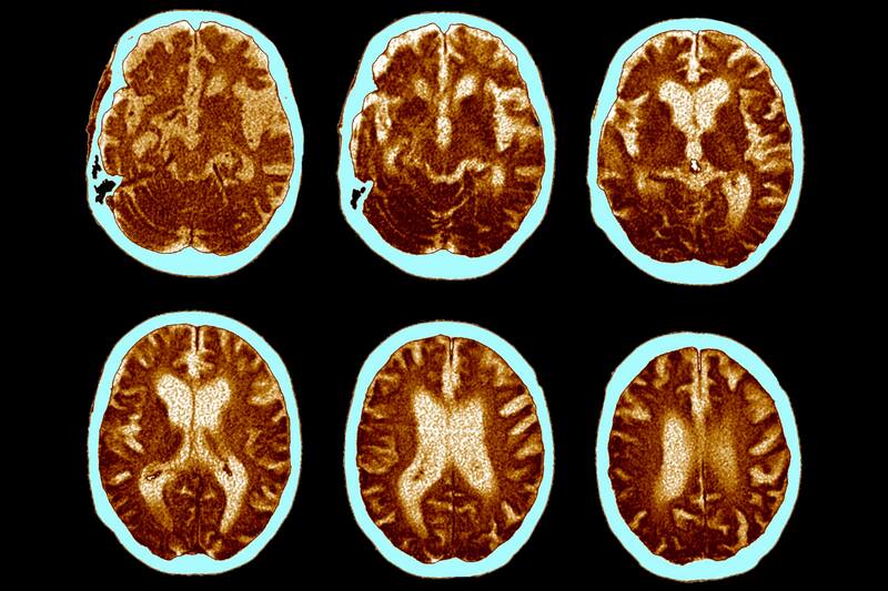 Este es un registro del avance de la enfermedad en el cerebro de una persona con Alzheimer