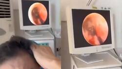 VIDEO | Fue al otorrino por un dolor de oído y descubrieron que una araña hizo un nido adentro