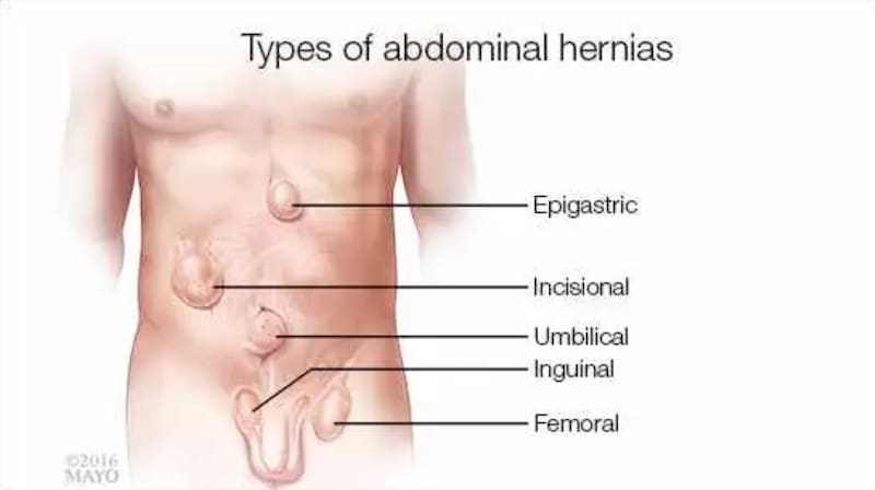 Estos son algunos de los tipos de hernias cubiertos por Fonasa PAD.