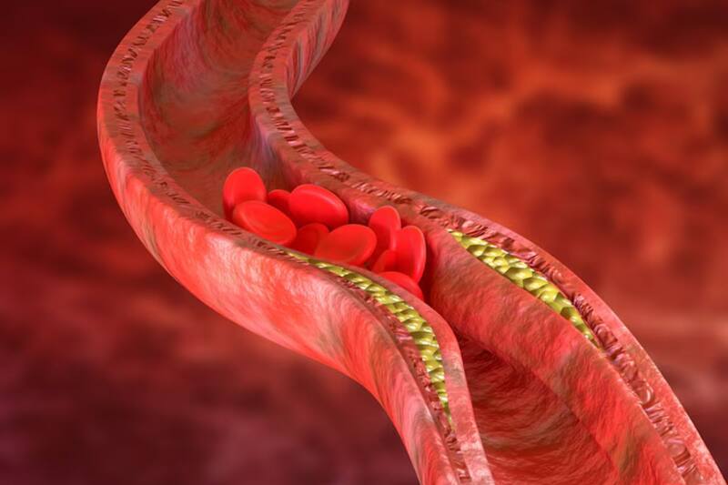 Esta condición puede ocasionar enfermedades cardiovasculares, según el Minsal.
Créditos: Freepik.