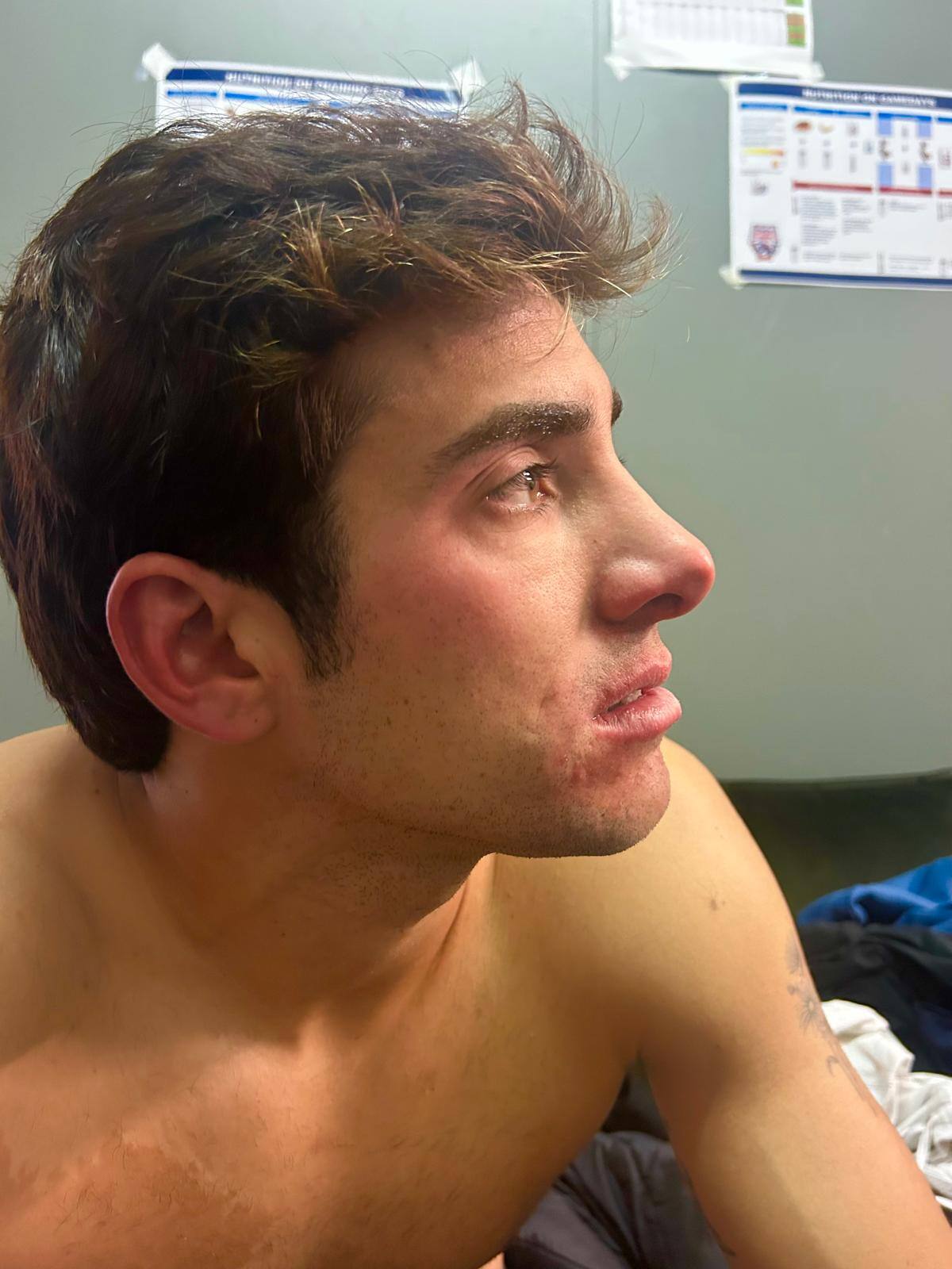 Así quedó su rostro tras la agresión sufrida en Copa Davis.