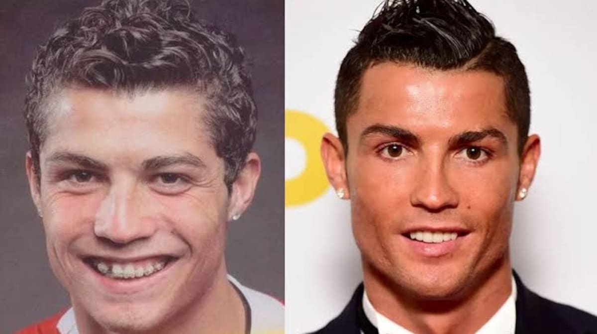 El antes y el después de su rinoplastía.