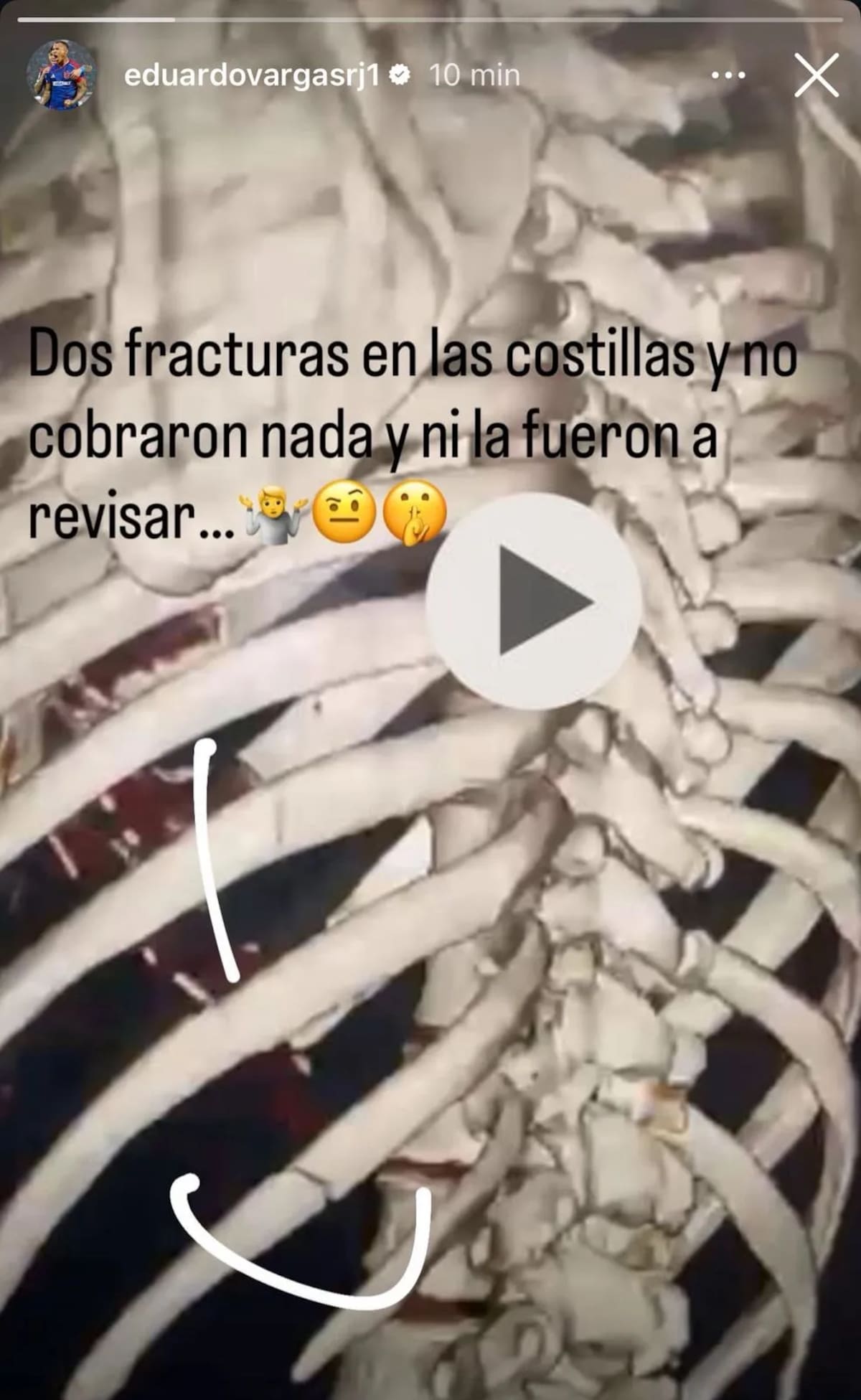 Evidenció en Instagram la lesión que sufrió ante O'Higgins. Foto: Captura.