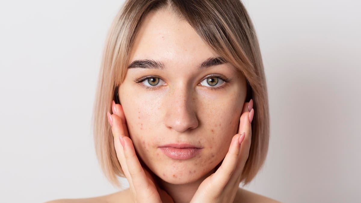 El remedio casero para eliminar acné, espinillas y grasa en la piel