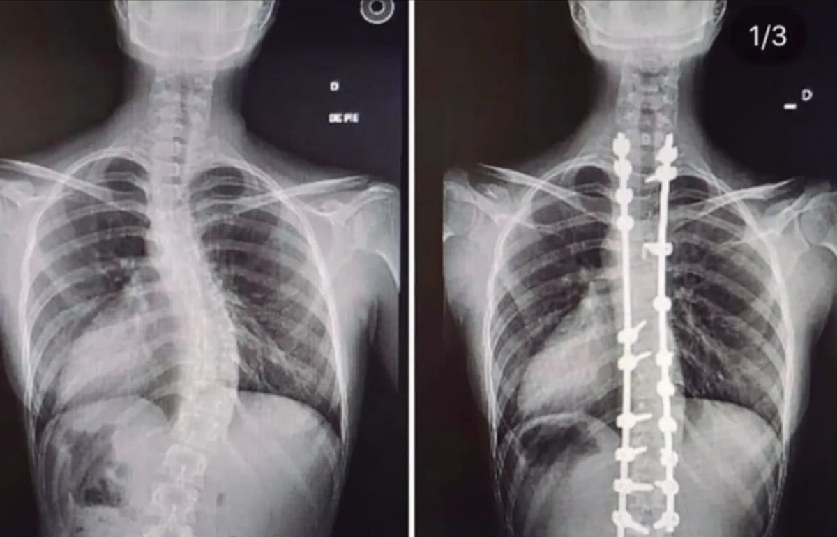 En sus redes sociales, la cientista política mostró cómo cambió su cuerpo tras someterse a una operación.