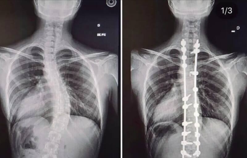 En sus redes sociales, la cientista política mostró cómo cambió su cuerpo tras someterse a una operación.