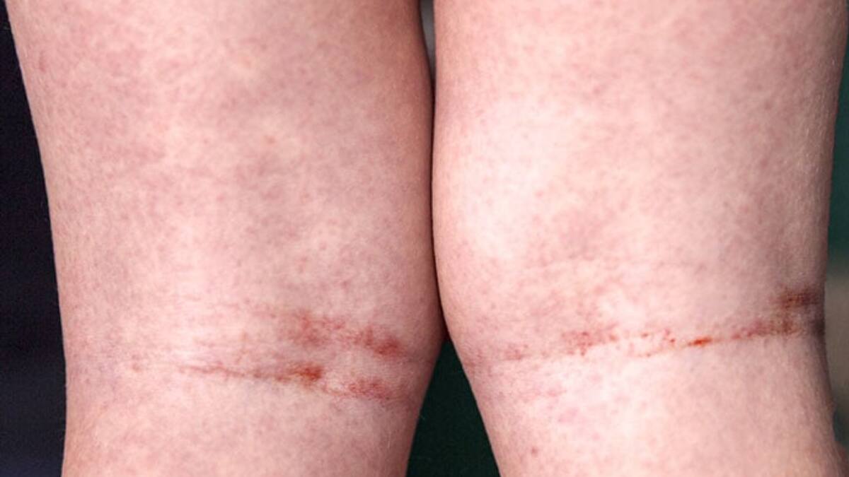 ¿Qué es la fiebre escarlatina? La enfermedad que preocupa en Talca tras confirmación de 5 casos