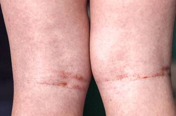 ¿Qué es la fiebre escarlatina? La enfermedad que preocupa en Talca tras confirmación de 5 casos