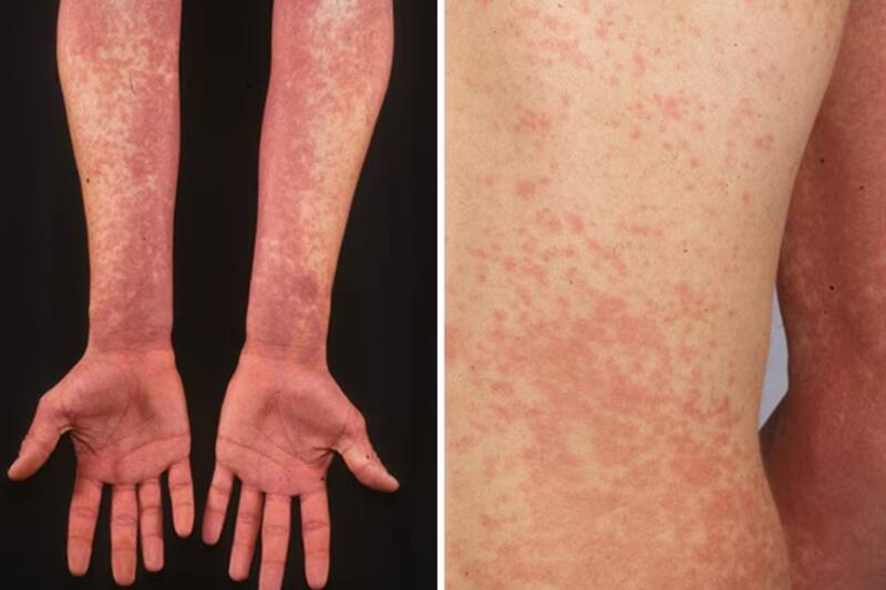 Es provocada por un grupo de bacterias que son contagiosas.