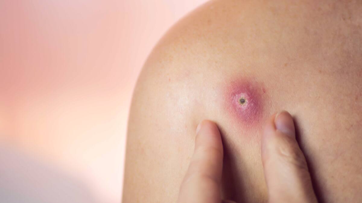 Forúnculos: tratamiento y prevención recomendados por la Clínica Alemana