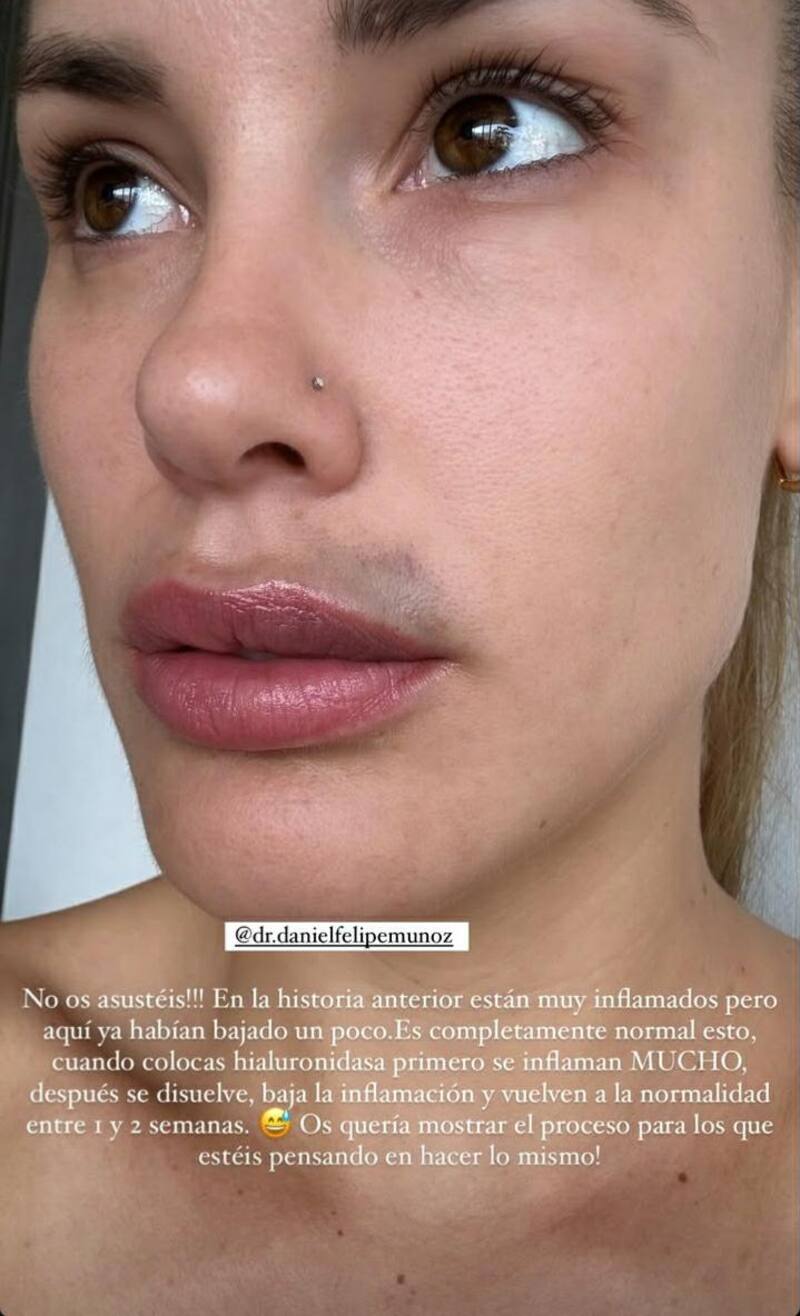sube historia sobre la evolución de sus labios.