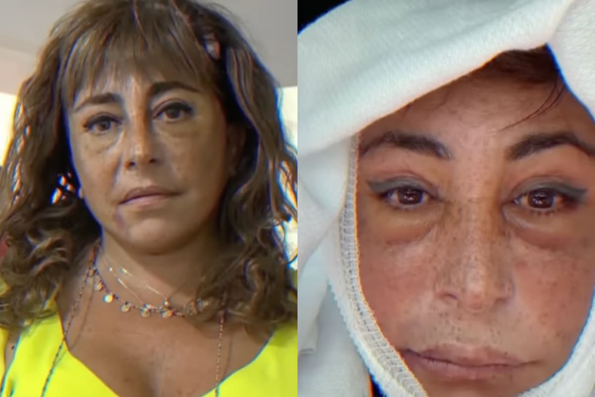 se sometió a compleja operación de rostro.