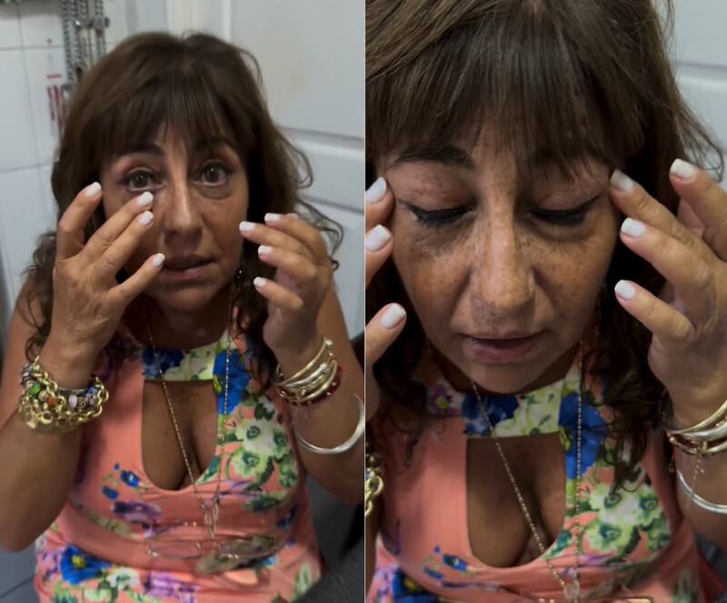 Helhue Sukni  y el avance de su intervención estetica.