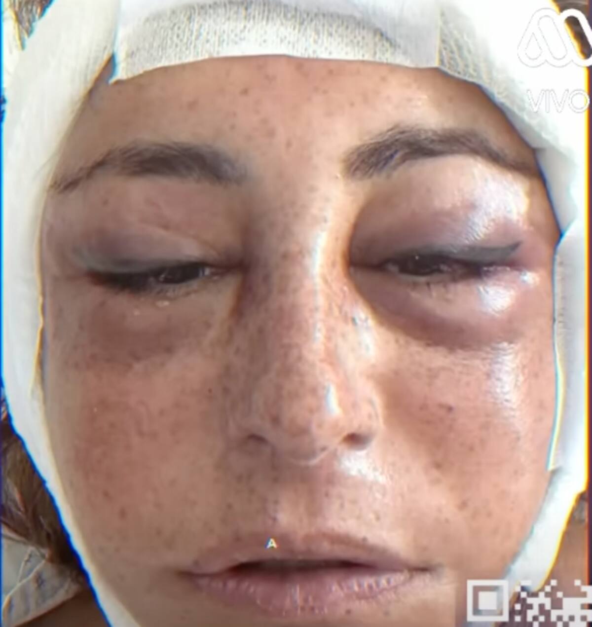 a los tres días de operada.