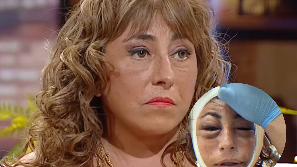 “El doctor me sacó toda la cara”: El impactante antes y después de Helhue Sukni tras peligrosa operación de rostro