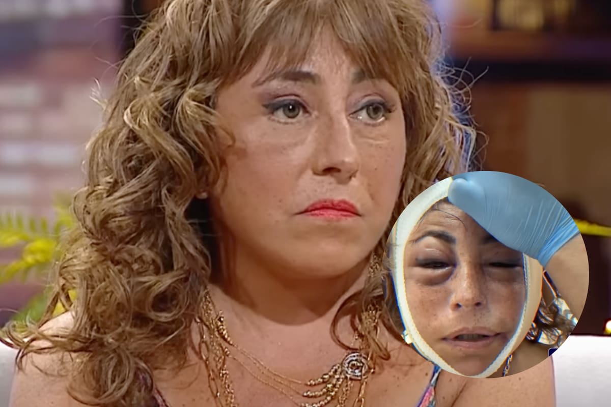 reveló detalles de su operación de rostro.