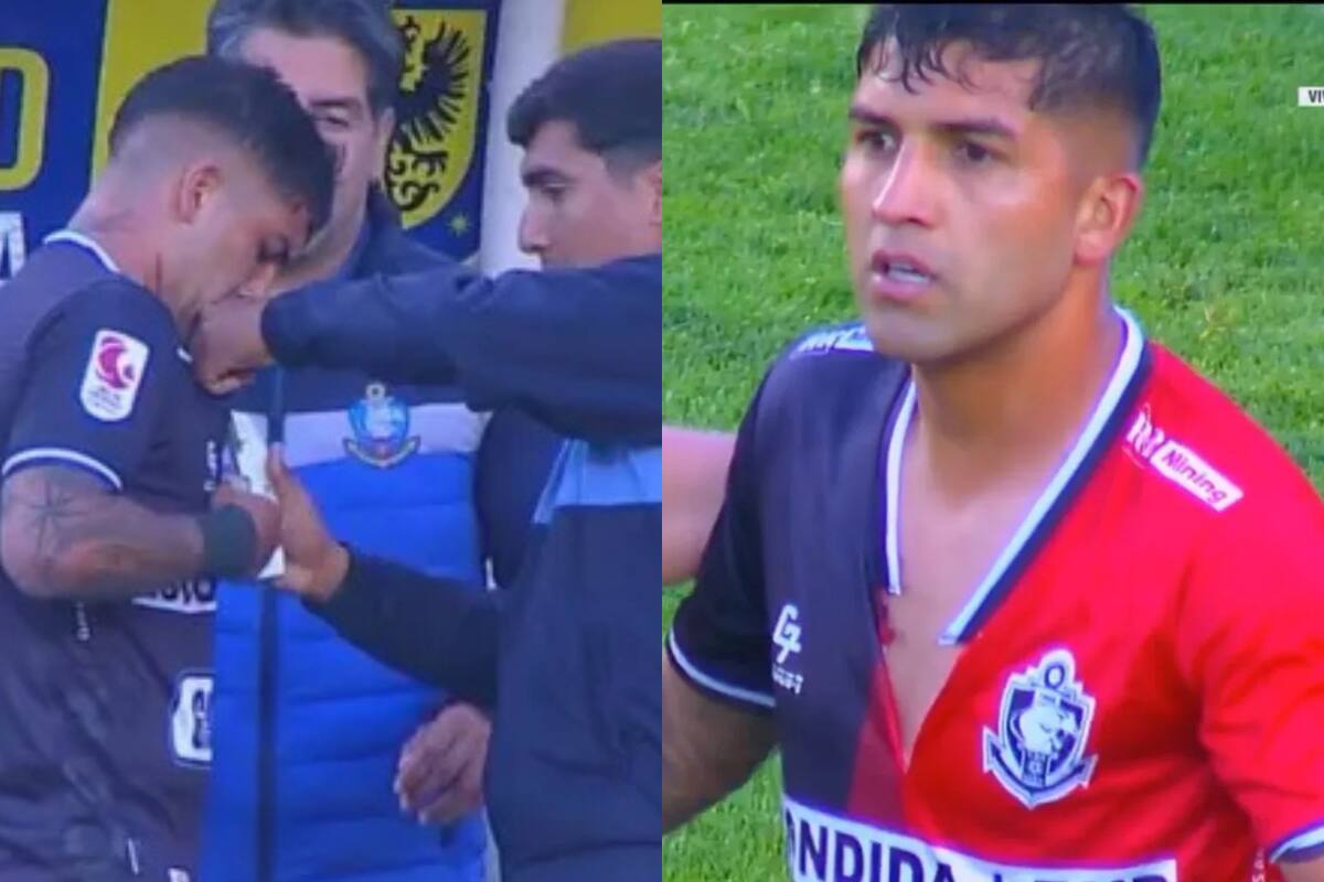 Le tuvieron que corchetear la polera.