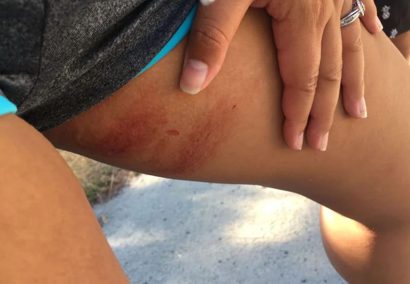 El calor trae consigo algunos molestos y dolorosos percances como la irritación por la sudoraión en los muslos: Foto: duradry.com