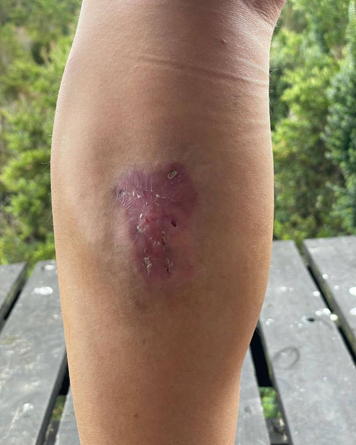 Sanó completamente su herida tras ser mordida por una araña de rincón.
