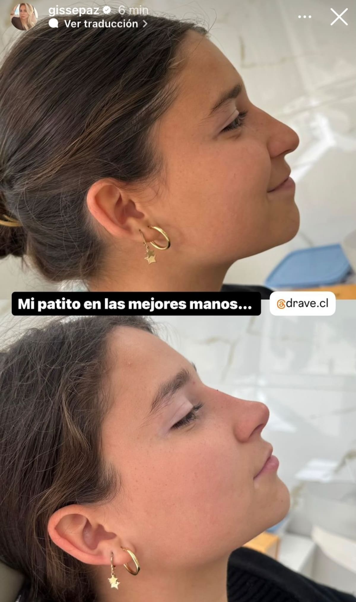 Matilde Pinilla se sometió a una rinomodelación.