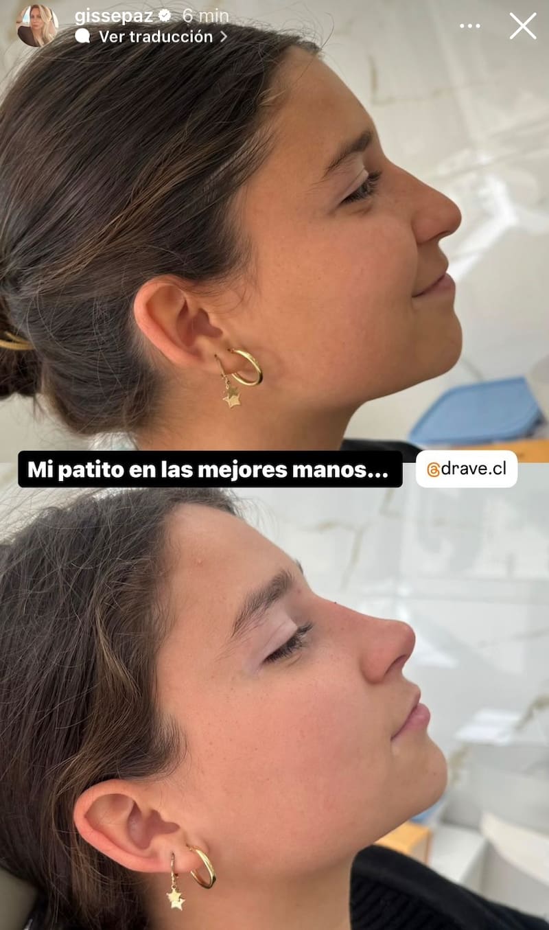 Matilde Pinilla se sometió a una rinomodelación.