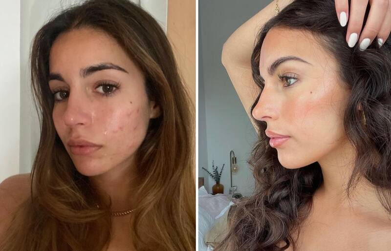 Mie Sofía Elers mostró el antes y el después en su rostro. Créditos: Instagram