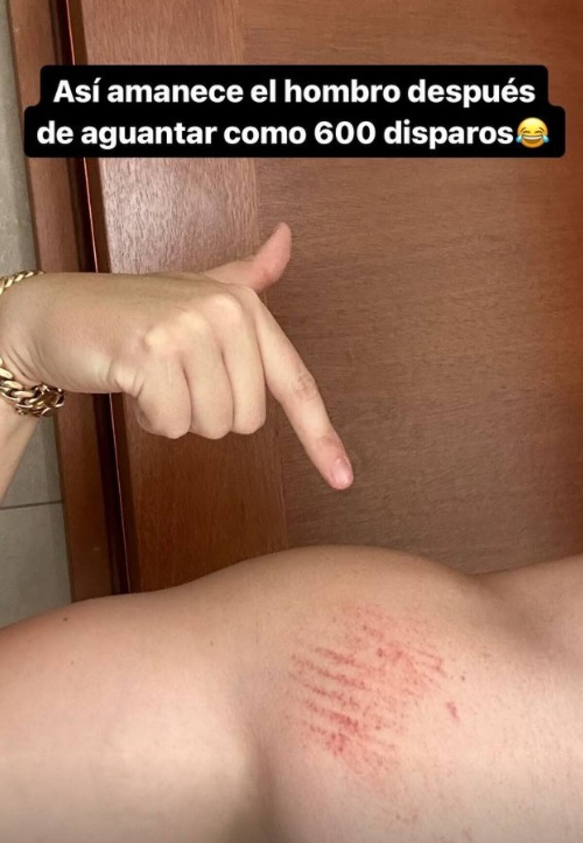 Nano Calderón mostró las secuelas tras manejas armas de guerra. Créditos: Instagram